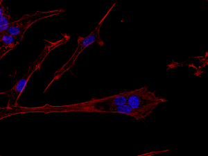 Beskrivelse: Billedet viser hjernekræftceller af typen glioblastoma multiforme i bevægelse, som er farvet for DNA (blå) og actin cytoskelet (rød). Cellen i centrum er polynukleær, hvilket vil sige, at den indeholder flere cellekerner og dermed mere DNA — hvilket ofte bliver associeret med kræft-stamceller. Og de er ret glade for at bevæge sig, hvilket kan ses på billedet ved den lange cellulære proces som strækker sig væk fra de blå cellekerner. Det er dén retning kræftcellen er på vej i. I patienter med denne type hjernekræft er det de invaderende (bevægende) kræftceller, som udgør et kæmpe problem, da man med nuværende behandling ikke kan få ram på dem. Ved at invadere det raske hjernevæv formår de at udnytte hjernens egne beskyttelsesmekanismer, som blandt andet forhindrer skadelige stoffer i at komme ind i hjernen og derved også en del mulige behandlingspræparater.