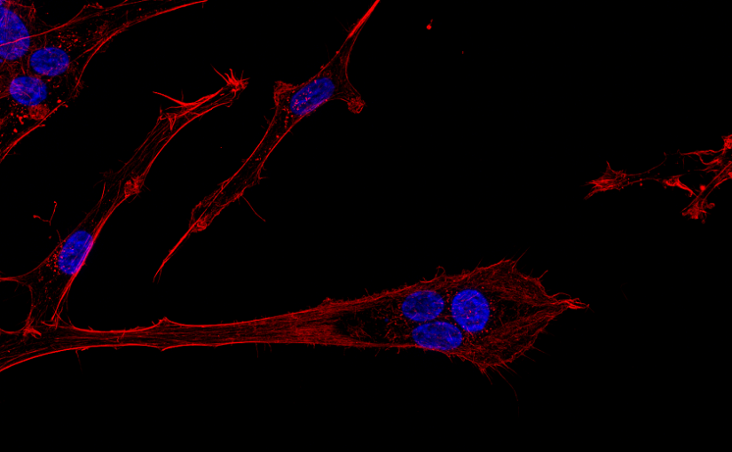 Billedet viser hjernekræftceller af typen glioblastoma multiforme i bevægelse, som er farvet for DNA (blå) og actin cytoskelet (rød). Cellen i centrum er polynukleær, hvilket vil sige, at den indeholder flere cellekerner og dermed mere DNA — hvilket ofte bliver associeret med kræft-stamceller. Og de er ret glade for at bevæge sig, hvilket kan ses på billedet ved den lange cellulære proces som strækker sig væk fra de blå cellekerner. Det er dén retning kræftcellen er på vej i. I patienter med denne type hjernekræft er det de invaderende (bevægende) kræftceller, som udgør et kæmpe problem, da man med nuværende behandling ikke kan få ram på dem. Ved at invadere det raske hjernevæv formår de at udnytte hjernens egne beskyttelsesmekanismer, som blandt andet forhindrer skadelige stoffer i at komme ind i hjernen og derved også en del mulige behandlingspræparater.