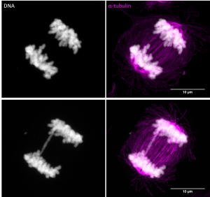 Mikroskopi-billede af to anafaseceller, hvor en af ​​dem oplever en såkaldt kromatin-bro.