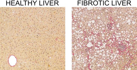 Two microscopy images in high resolution of a healthy liver and a fibrotic liver clearly show the cellular difference between the two conditions.